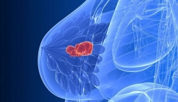 10 تصور اشتباه در مورد سرطان پستان