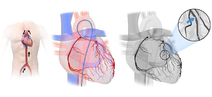 کاتتریزاسیون و آنژیوگرافی تشخیصی قلب و عروق